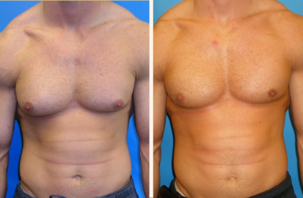 a148d-gynecomastia-case4-frontal-lg.jpg