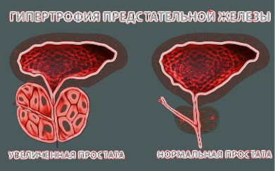 gipertrofiya-predstatelnoy-zhelezy.jpg