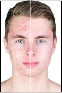 akne-na-kurse.jpg